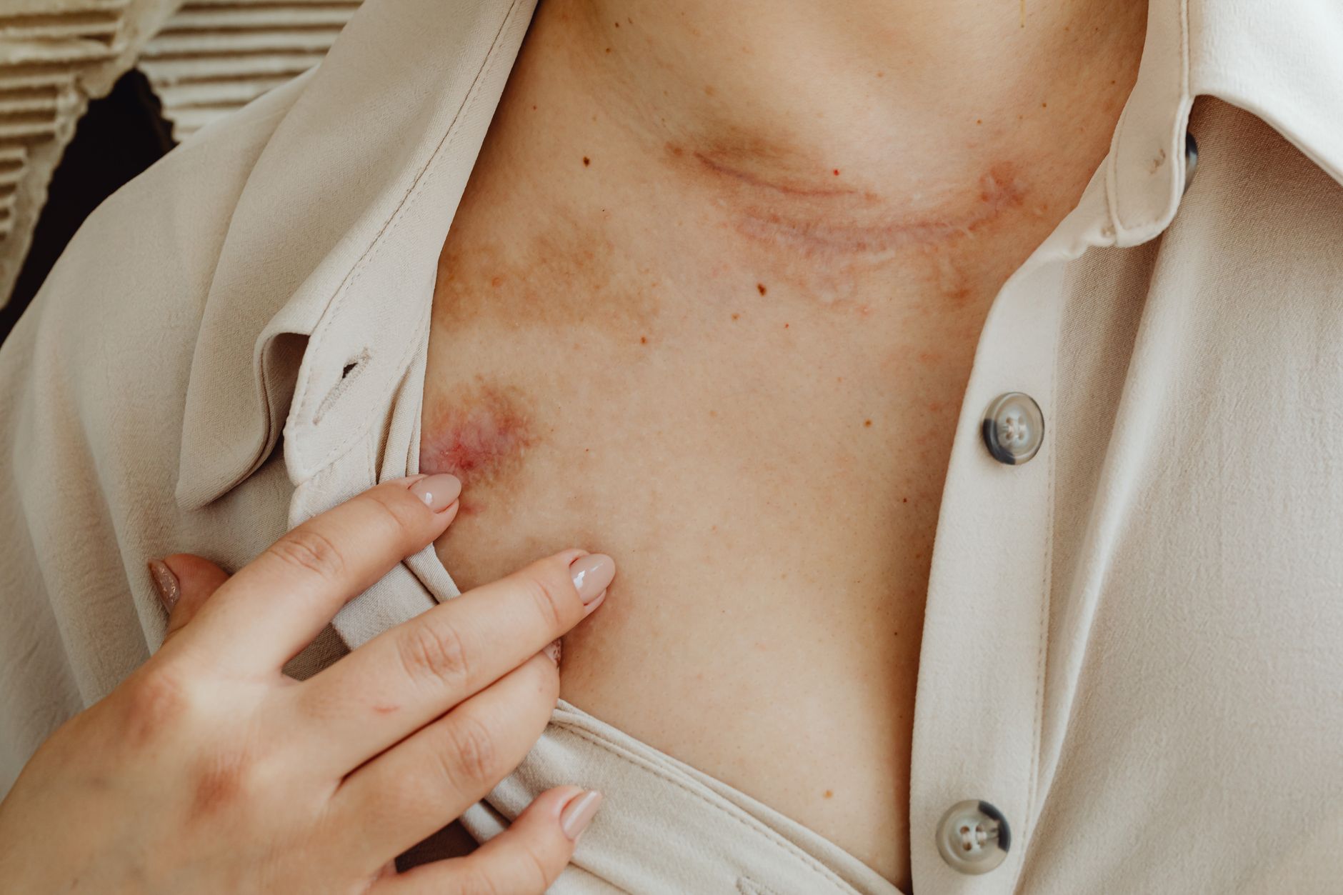 tratamento-queimadura-de-terceiro-grau Close-up view of scarred skin on chest with a hand gently touching, symbolizing healing.